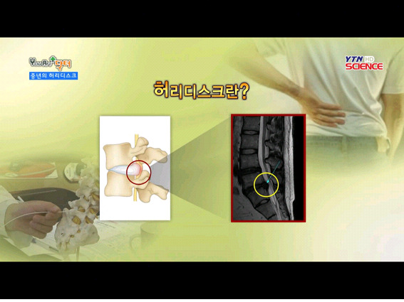 국민병 - 허리 디스크의 모든 것
